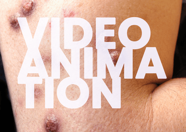 The Pathophysiology of Prurigo Nodularis