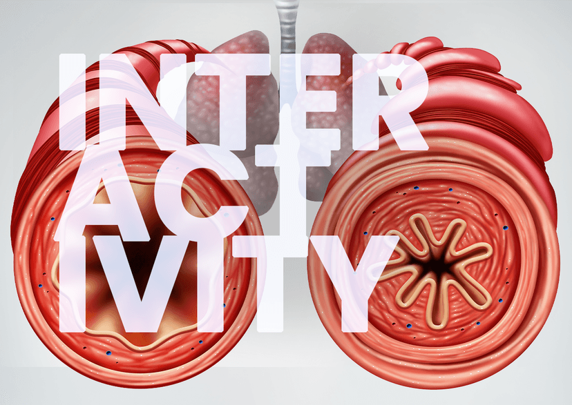 Airway Hyperresponsiveness In Asthma Is Mainly Driven By Components Of Type 2 Inflammation
