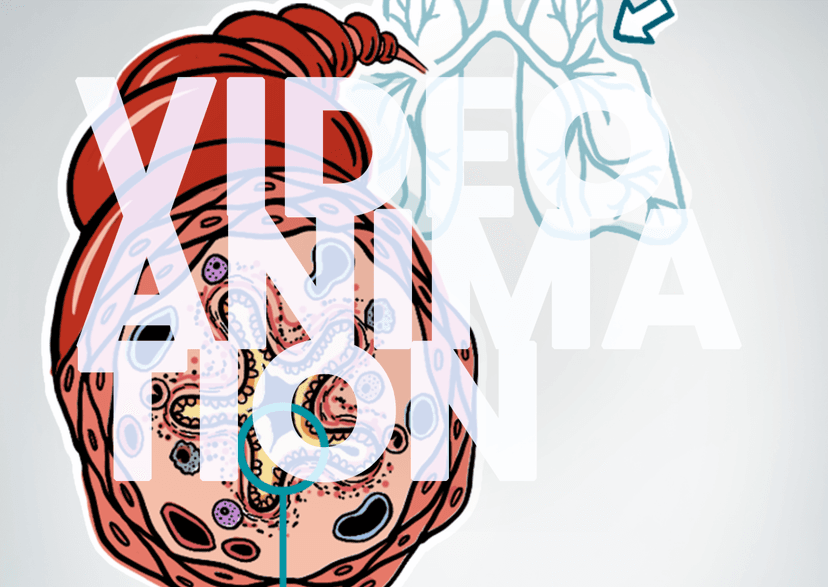 <b>Type</b> <b>2</b> <b>Inflammation</b> and Airway Remodeling Drive Lung Function Decline