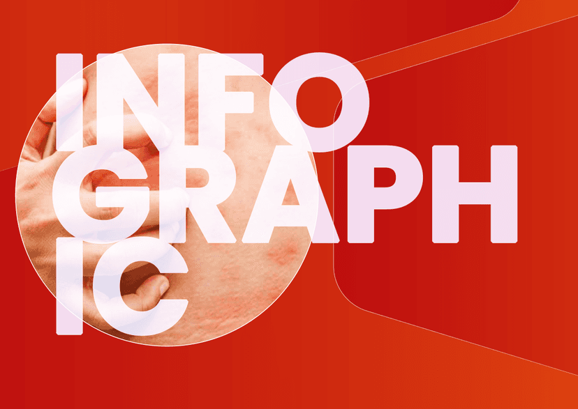 The Role of IL-4 and IL-13 in CSU