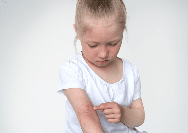 Skin Barrier Dysfunction and the Increased Risk For Allergen Sensitization in Children With Atopic Dermatitis