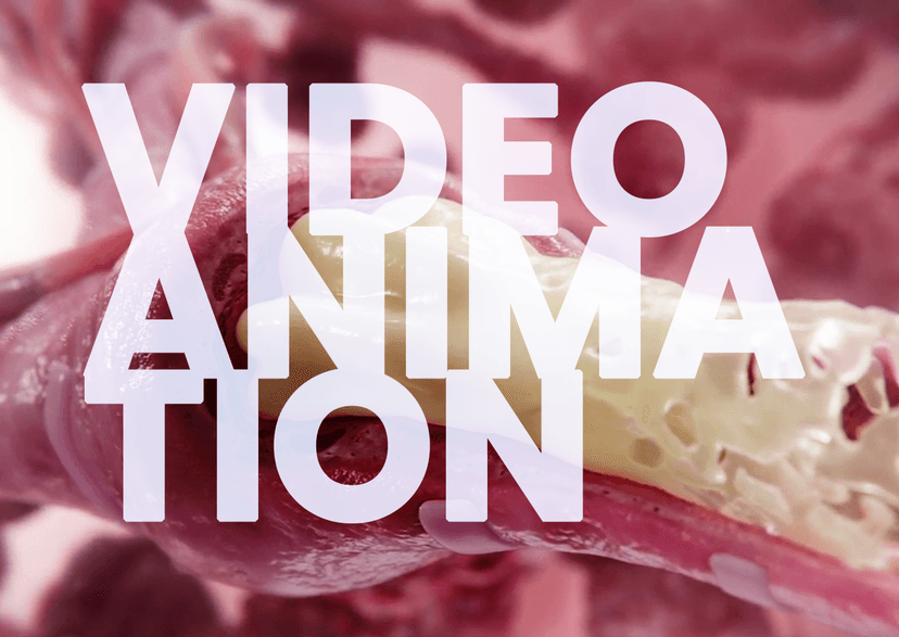 Screen depicting a mucus plug in the airways