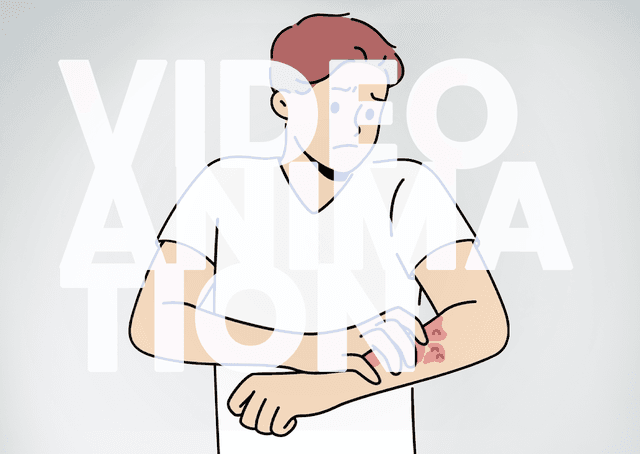 The Impact of Skin Fibrosis in Patients with Prurigo Nodularis
