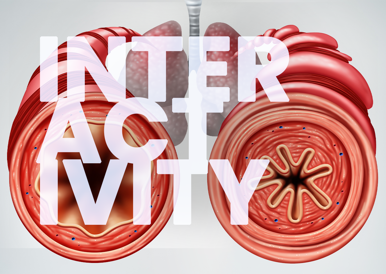 Airway Hyperresponsiveness In Asthma Is Mainly Driven By  Components Of Type 2 Inflammation