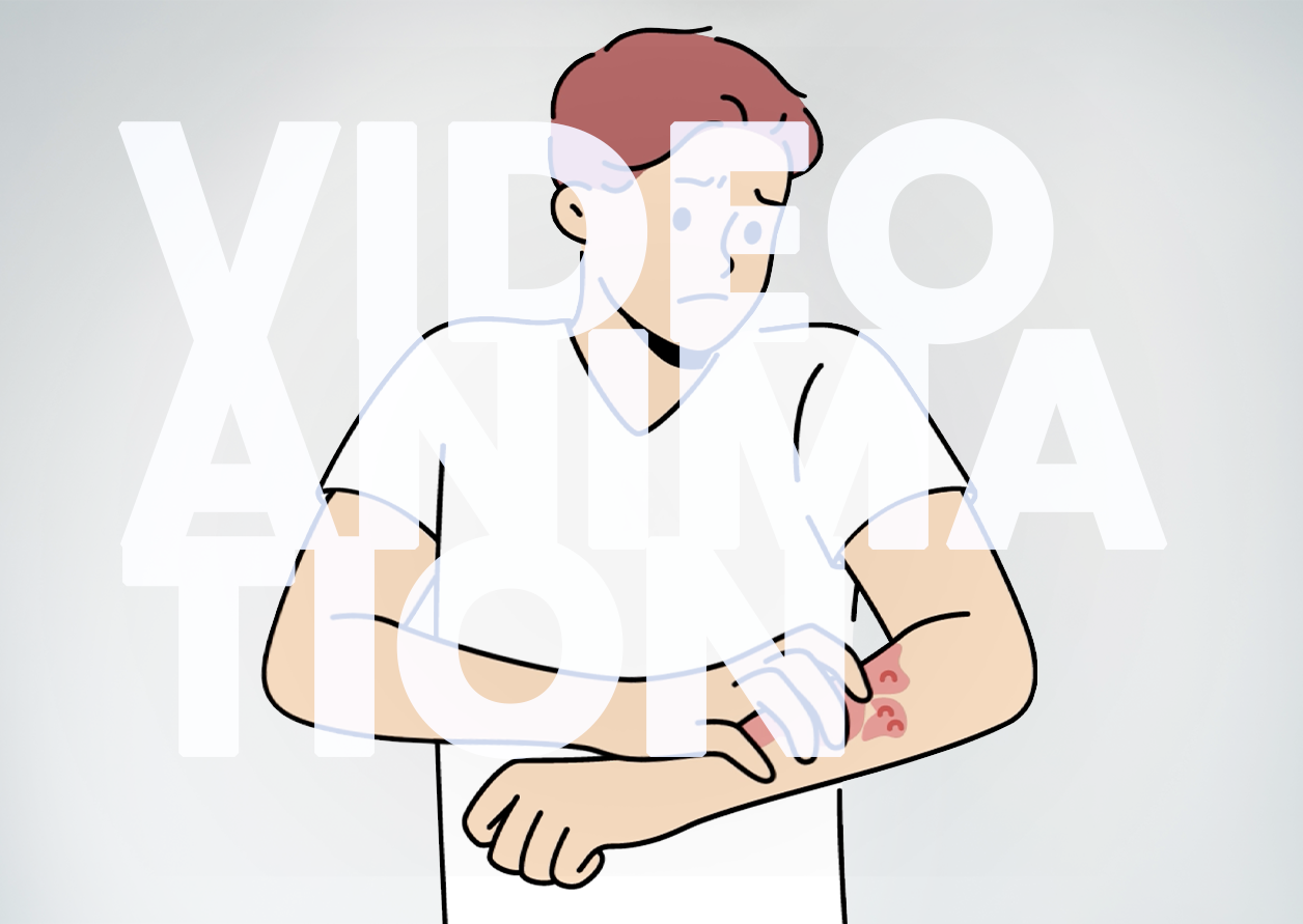 The Impact of Skin Fibrosis in Patients with Prurigo Nodularis